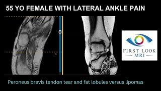 Peroneus brevis tendon tear and fatty lobules in foot [upl. by Ignace]