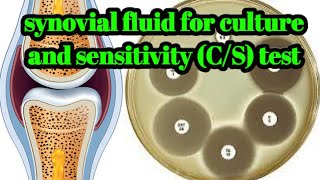 Synovial Fluid for Culture and Sensitivity CS test hindiurdu [upl. by Bores]