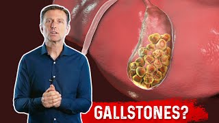 What is a Gallbladder Attack – Symptoms amp Causes Covered by DrBerg [upl. by Gilpin]