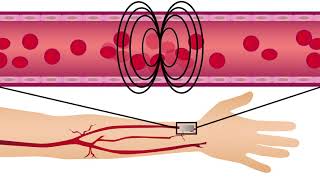 A new method for tracking endothelial dysfunction and heart disease risk in patients with diabetes [upl. by Valeta275]