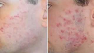 FAST Acne Scars Removal With Revitol [upl. by Irep]