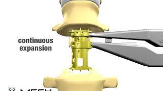 DepuySynthes Depuy X Mesh Expandable Cage [upl. by Themis]