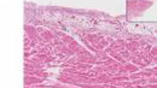 Histopathology HeartAcute fibrinous pericarditis [upl. by Nicodemus]