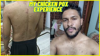 MY CHICKEN POX EXPERIENCE 🥺 HOW to REMOVE CHICKEN POX DARK SPOTS  Zahid Akhtar [upl. by Ruperta]