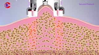 How Vacuum RF Fat Reduction Skin Tightening Treatment WorkSlimming Lymphatic Drainage Machine [upl. by Ived527]