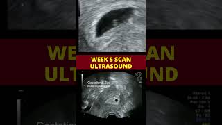 Ultrasound scan week 5  pregnancy scan [upl. by Evvie]