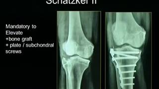 Tibial Plateau Fractures [upl. by Gere]