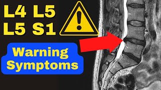 WARNING These Are The 3 MAJOR Symptoms of a Severe L4 L5 L5 S1 Disc Bulge  Dr Walter Salubro [upl. by Earised]