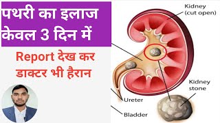 kidney stone treatment by doctor kidneystoneremoval kidneystonekailaj [upl. by Adnorrehs]