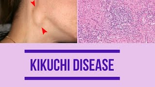 Kikuchi disease  Factors  Clinical features  Diagnosis  histopathology  Management [upl. by Ahseei]