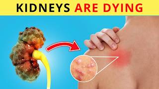 9 Kidney Failure Symptoms You Need to Know  Essential Tests to Avoid Dialysis [upl. by Kennedy229]