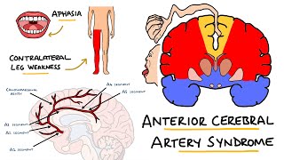 Anterior Cerebral Artery Stroke Syndrome  ACA Stroke Syndrome  Stroke Syndromes [upl. by Hill]