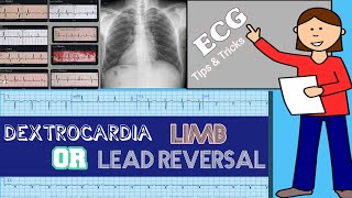 Differentiating Dextrocardia From Limb Lead Reversal On ECG [upl. by Ensign]