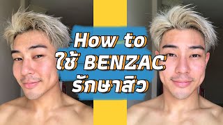 สิวหายแล้ว สอนทา Benzac เบนแซค อย่างละเอียด  อัพเดทผิวหลังใช้ 1 เดือน  FFLOG [upl. by Nnail222]