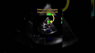 Severe Pulmonary Valve Regurgitation on Echocardiography [upl. by Desireah]