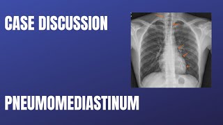 Case Discussion  Pneumomediastinum [upl. by Ursas726]