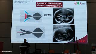 Video 2 Corpus Callosum Diagnosis [upl. by Caron]