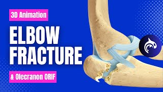 Elbow Olecranon Fracture and Fixation  3D Animation [upl. by Case]