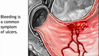 Stomach Ulcer Animation  Peptic Ulcer Disease Causes Symptoms Treatment  Gastric Anatomy [upl. by Nyrraf728]