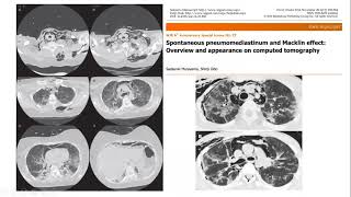 Pneumomediastinum and COVID [upl. by Ulita846]