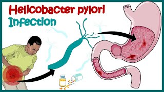 Helicobacter Pylori Infection  Gastric ulcer  Causes Signs and Symptoms Diagnosis and Treatment [upl. by Ytteb66]