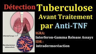 Dépistage de Tuberculose latent avant AntiTNF infection tuberculeuse pulmonaire IDR interféron Gamma [upl. by Alyled465]