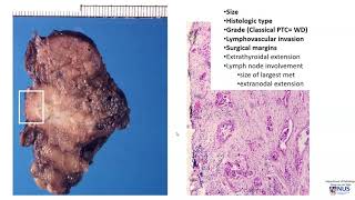 Thyroid carcinoma II Pathology evaluation [upl. by Kassia767]