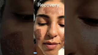 We Treated Her Acne in just One Day 😱skincare beauty shorts laser [upl. by Sucam]