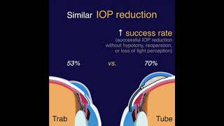 TVT  Tube vs Trab Study [upl. by Aney]