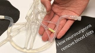 How neurosurgeons remove blood clots [upl. by Wanonah]