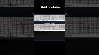 Atrial Fibrillation ECG Fibrillatory f Waves [upl. by Sklar295]