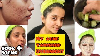 How to Make Your Acne Disappear Overnight  4 Home Remedies For Pimples [upl. by Moss]