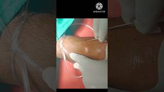 cannula insertion in footshorts [upl. by Aldus711]