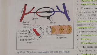 Overview of Diabetic Retinopathy  EYE [upl. by Hcra]