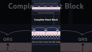 Third Degree Atrioventricular Block ECG QRS complexes [upl. by Nilkcaj]