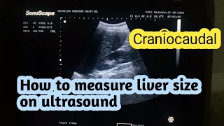 How to Measure liver on ultrasoundCraniocaudal view [upl. by Yvehc]