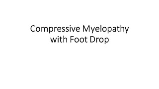 Compressive Myelopathy with Foot Drop [upl. by Layla]