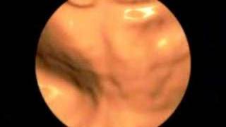 3D Medical Animation of a Colonoscopy [upl. by Relyt]