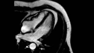 Constrictive pericarditis fourchamber ECGgated cine SSFP MR [upl. by Melise]