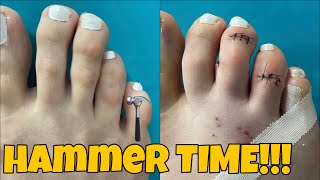 MINIMALLY INVASIVE HAMMERTOE SURGERY [upl. by Urd991]