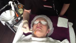 NeoStrata Glycolic Acid Skin Peel UK in Droitwich Clinic Worcestershire [upl. by Nivlac]