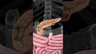 🔬 Mucinous Cystic Neoplasm of the Pancreas Understanding the Risks [upl. by Neveda476]