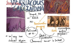 Verrucous carcinoma [upl. by Roxane]