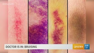 Why bruising matters and what the purple blue and yellow marks can indicate [upl. by Mena]