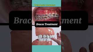 Braces Results braces bracesoff [upl. by Hadria]