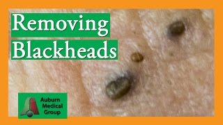 Several Blackheads  Auburn Medical Group [upl. by Cappello785]