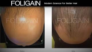 FOLIGAIN High Performance Hair Solutions [upl. by Minor]