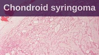 Chondroid Syringoma  Pathology mini tutorial [upl. by Pappano]