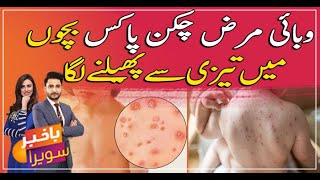 Chickenpox in Children  Symptoms Diagnosis and Treatment  Watch video [upl. by Helbonnah]