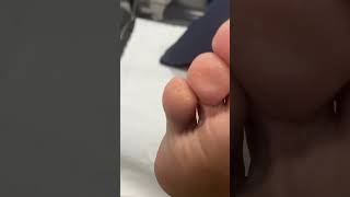 Watch how Australian podiatrist masters pinch callus removal PodiatryMagic CallusFree [upl. by Ag]